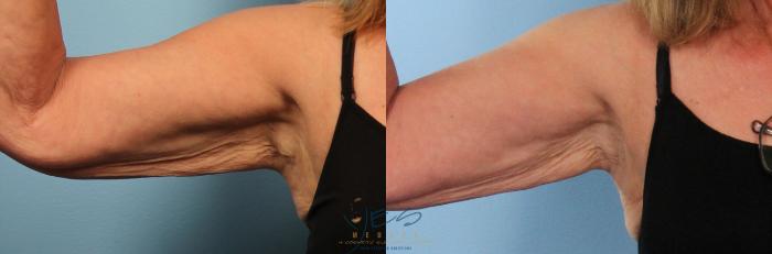 Before & After Evolve Tite / Venus BodyFx Case 410 Front - 90 Degree - Right View in Vancouver, BC