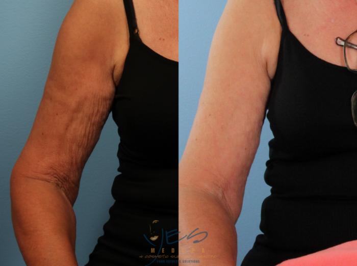 Before & After Evolve Tite / Venus BodyFx Case 410 Front - Bend Elbow - Right View in Vancouver, BC