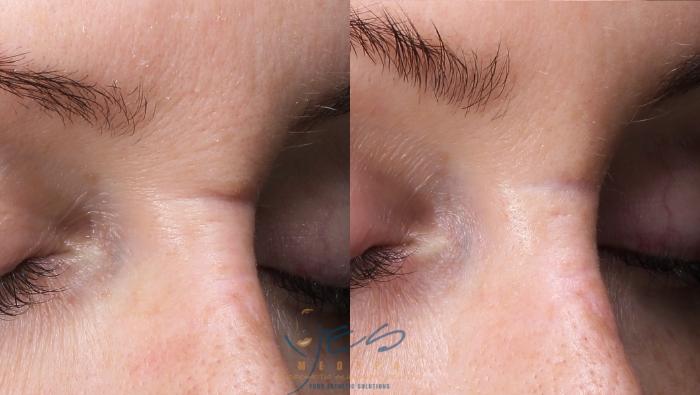 Before & After PRP Rejuventation Case 423 Right Oblique View in Vancouver, BC
