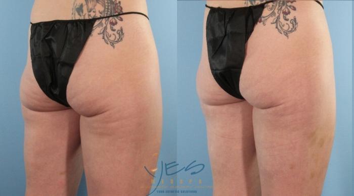 Before & After Morpheus8 Case 460 Right Oblique View in Vancouver, BC