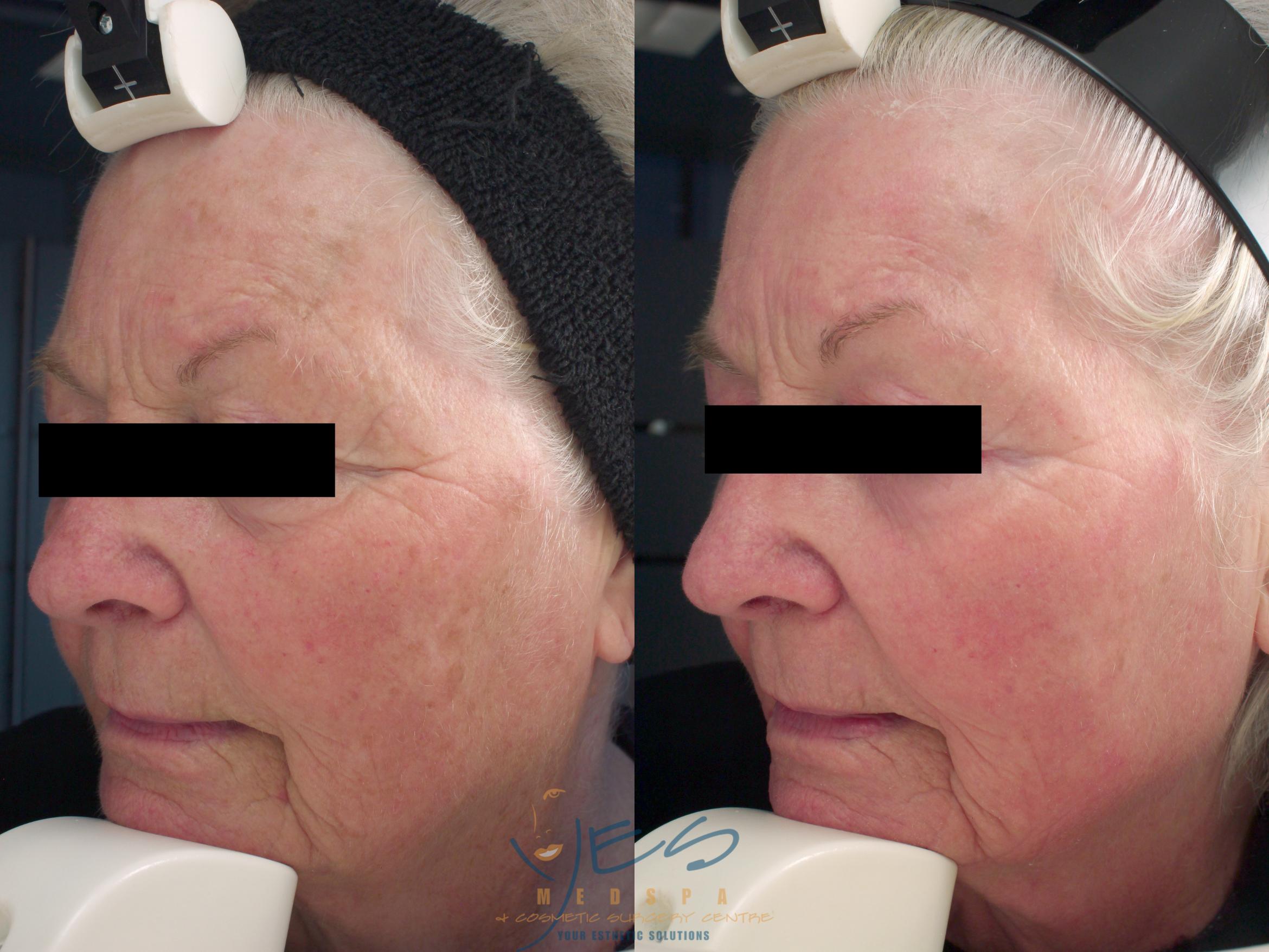 Before & After Photorejuvenation (IPL) Case 211 View #1 View in Vancouver, BC