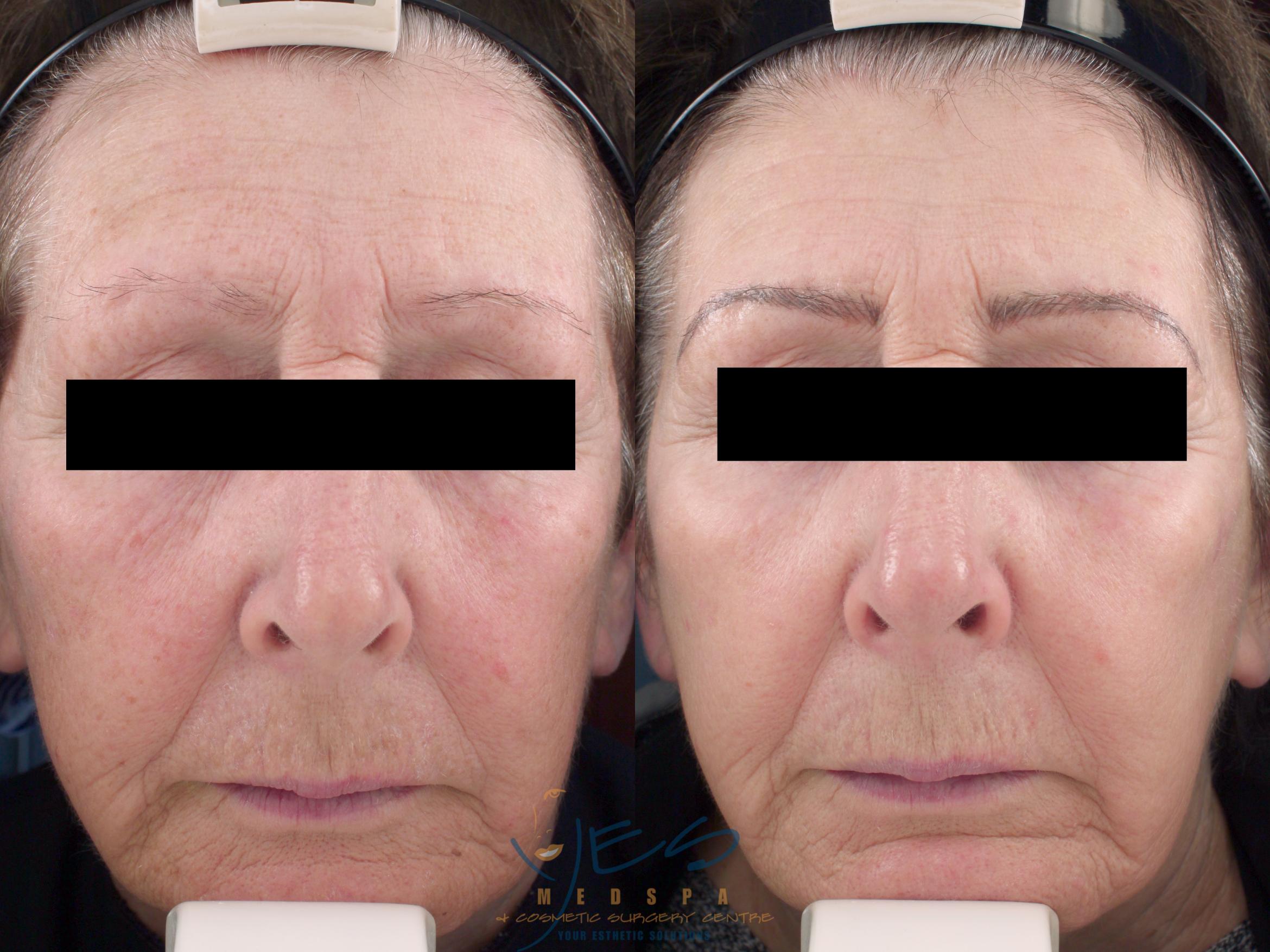 Before & After Photorejuvenation (IPL) Case 214 View #1 View in Vancouver, BC