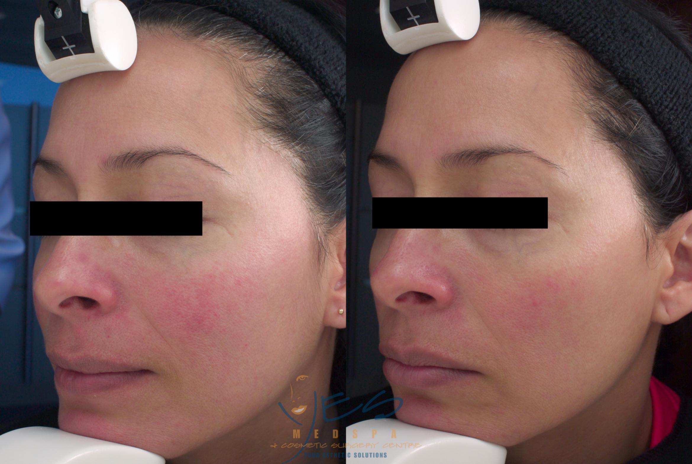 Before & After Photorejuvenation (IPL) Case 215 View #1 View in Vancouver, BC