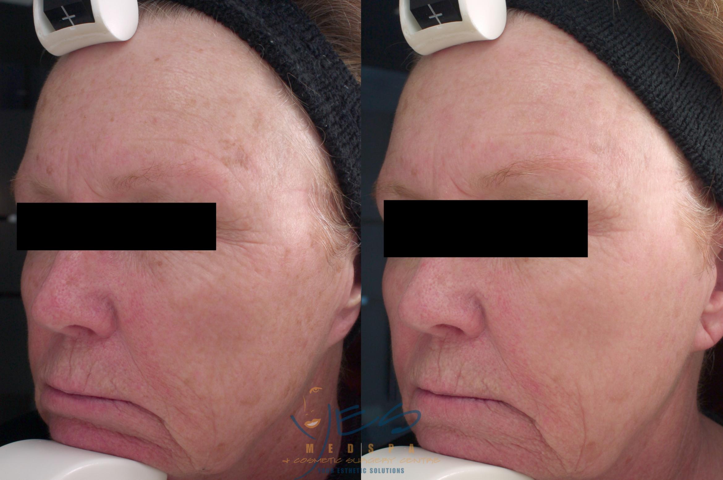 Before & After Photorejuvenation (IPL) Case 216 View #1 View in Vancouver, BC