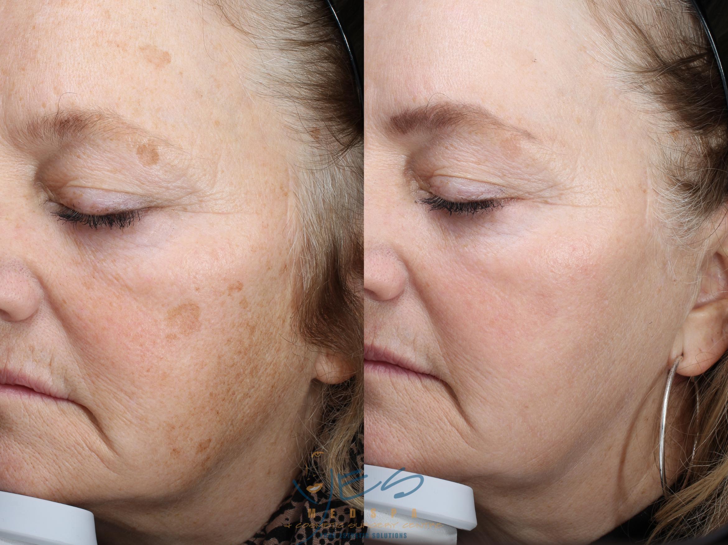 Before & After Photorejuvenation (IPL) Case 270 Left Side View in Vancouver, BC
