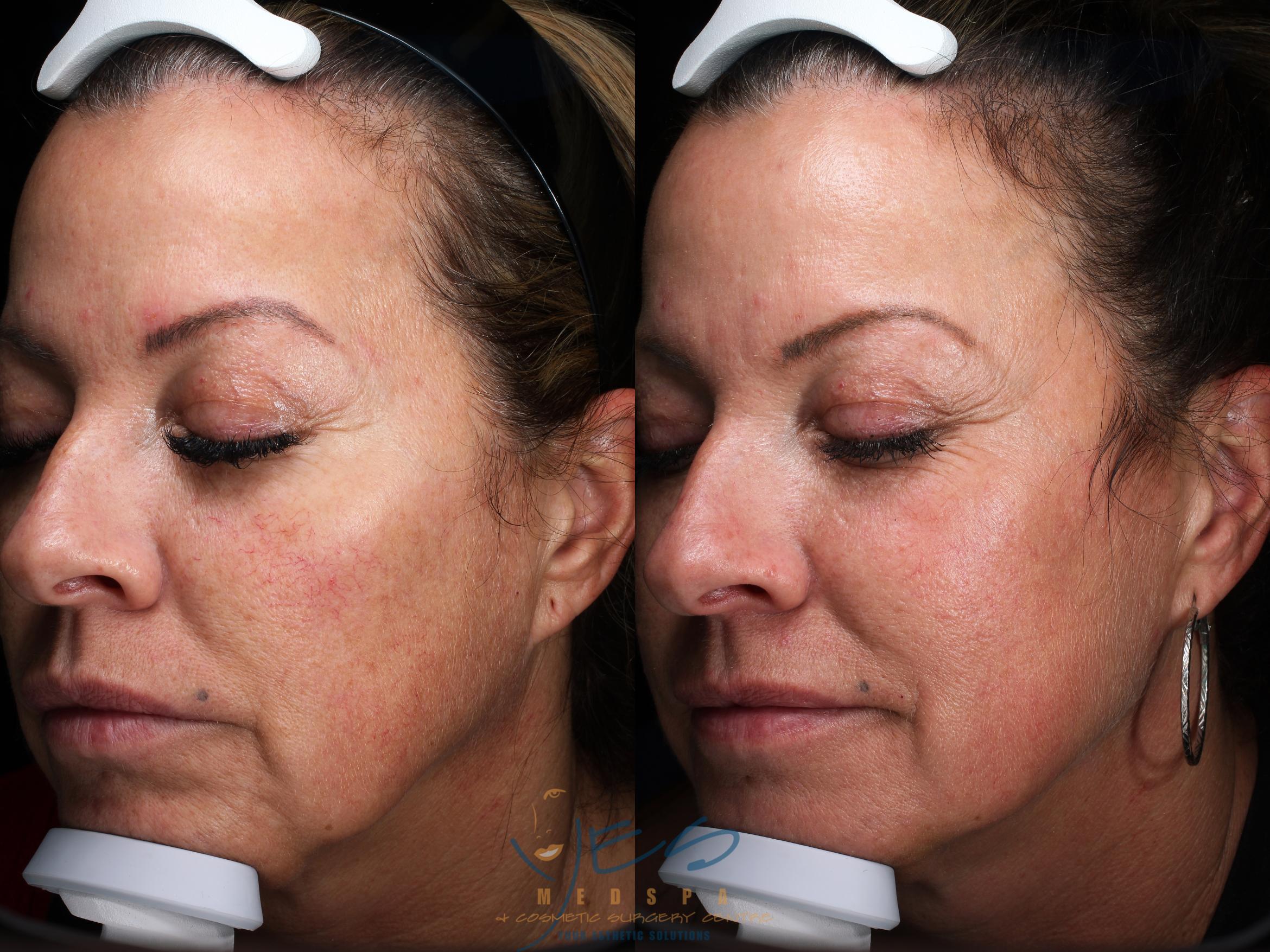 Before & After Photorejuvenation (IPL) Case 336 Left Side View in Vancouver, BC