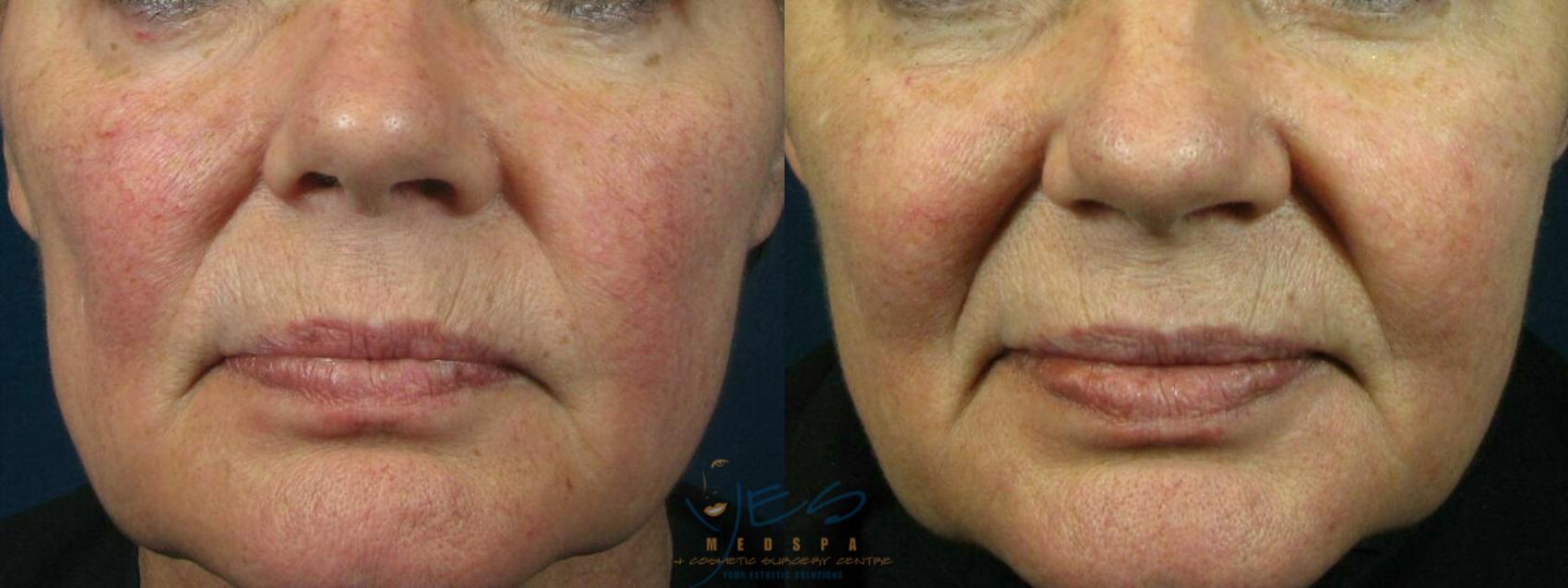Before & After Photorejuvenation (IPL) Case 120 Front View in Vancouver, BC