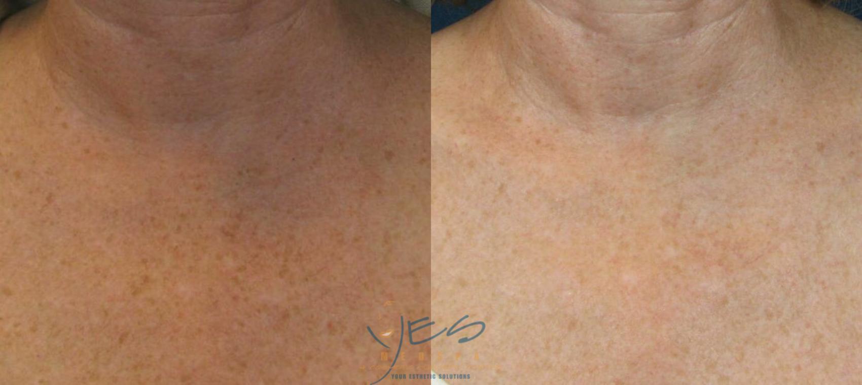 Before & After Photorejuvenation (IPL) Case 123 View #1 View in Vancouver, BC
