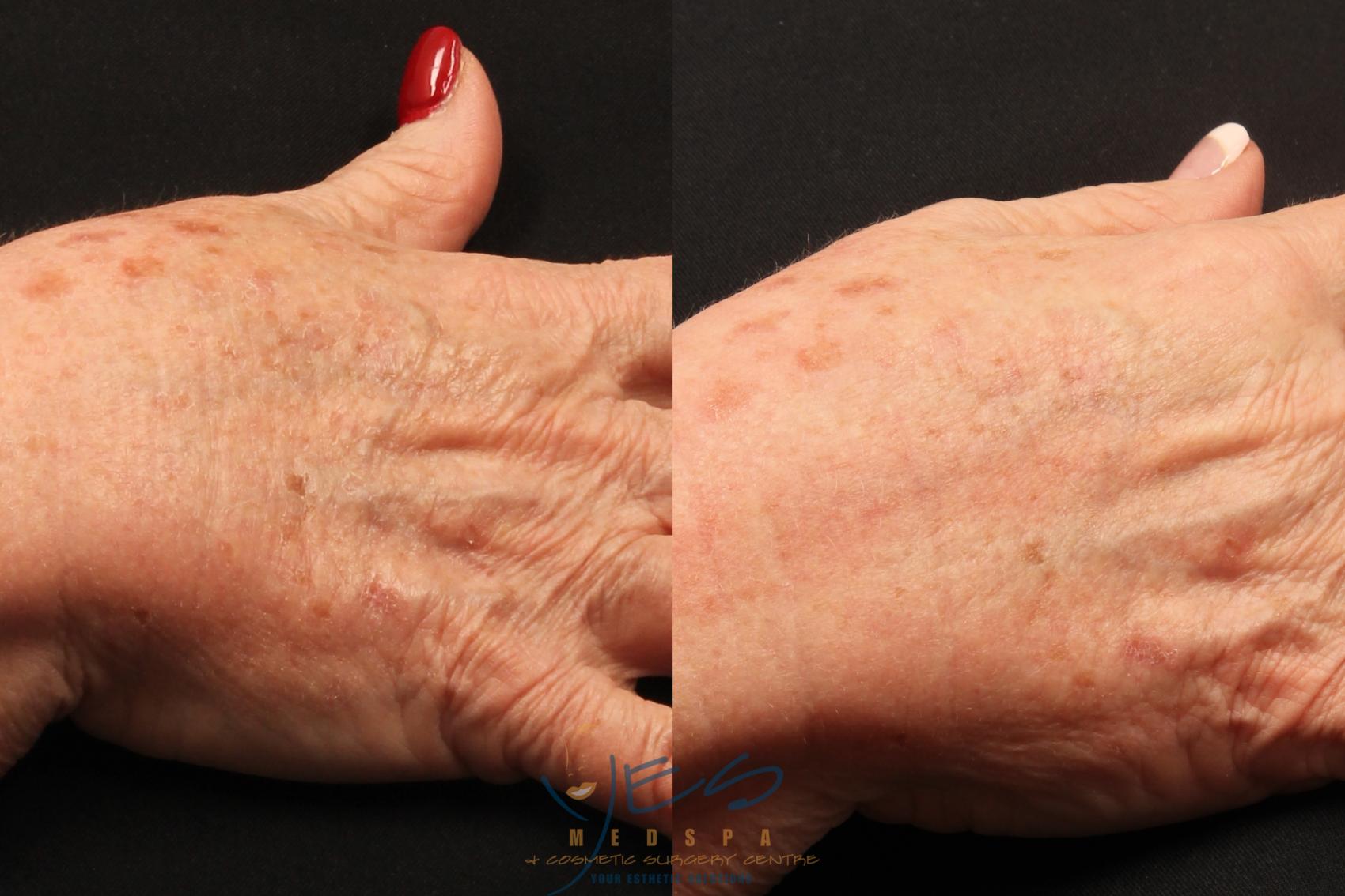 Before & After Photorejuvenation (IPL) Case 212 View #1 View in Vancouver, BC