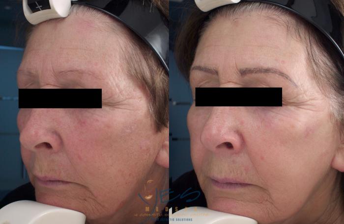 Before & After Photorejuvenation (IPL) Case 214 View #2 View in Vancouver, BC