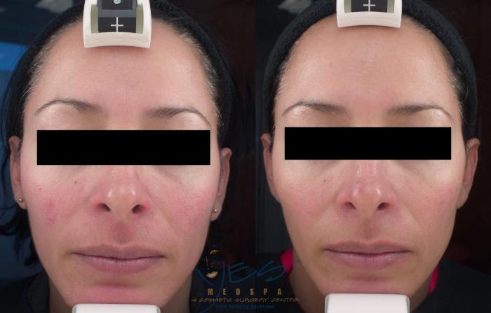 Before & After Photorejuvenation (IPL) Case 215 View #2 View in Vancouver, BC