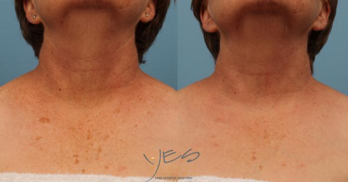 Before & After Photorejuvenation (IPL) Case 216 View #2 View in Vancouver, BC