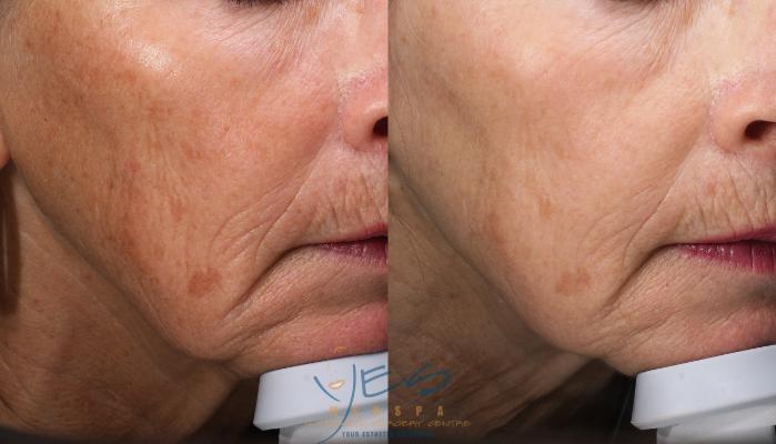 Before & After Photorejuvenation (IPL) Case 398 Right Oblique View in Vancouver, BC