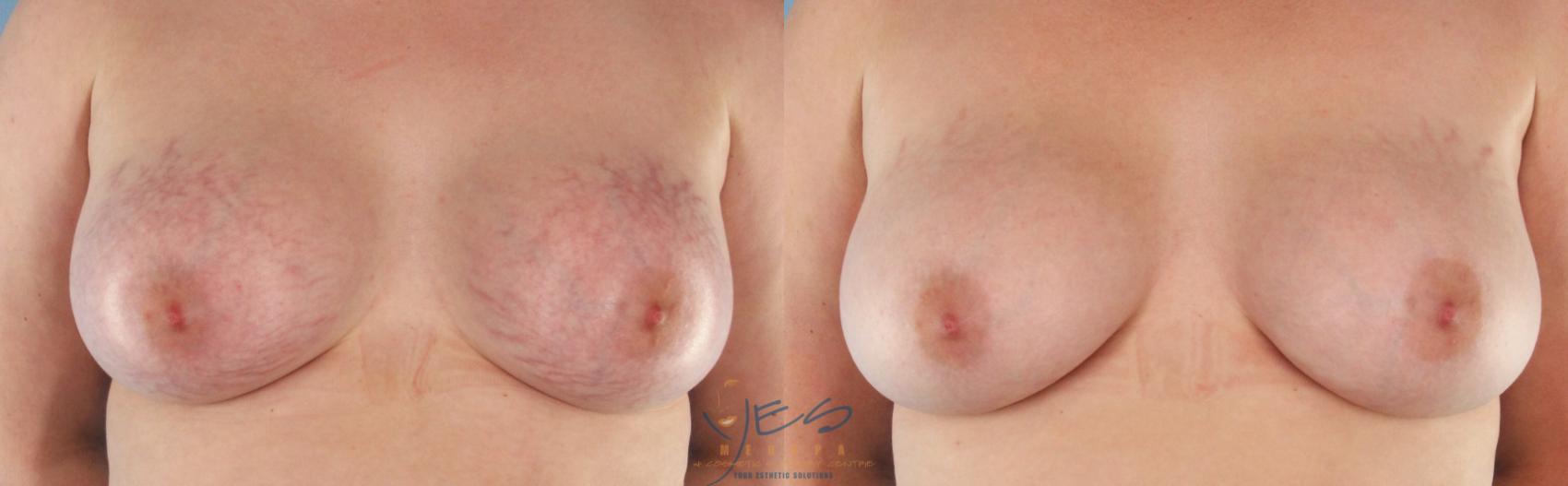 Before & After Photorejuvenation (IPL) Case 416 Front View in Vancouver, BC