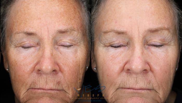 Before & After Photorejuvenation (IPL) Case 434 Front View in Vancouver, BC