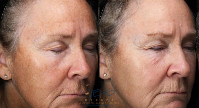 Before & After Photorejuvenation (IPL) Case 434 Right Oblique View in Vancouver, BC