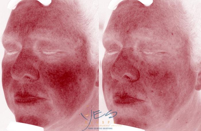 Before & After Photorejuvenation (IPL) Case 601 Filtered Light - Red View in Vancouver, BC