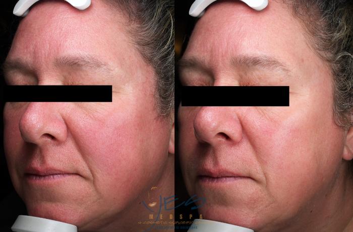 Before & After Photorejuvenation (IPL) Case 601 Left Side View in Vancouver, BC