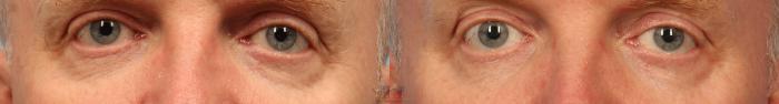 Before & After PRP Rejuvenation Case 427 Front View in Vancouver, BC
