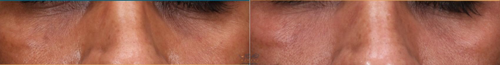 Before & After Skin Care Programs & Chemical Peels Case 438 Front View in Vancouver, BC