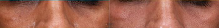 Before & After Skin Care Programs & Chemical Peels Case 438 Front View in Vancouver, BC