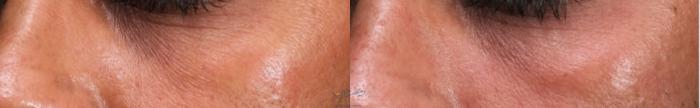 Before & After Skin Care Programs & Chemical Peels Case 438 Left Oblique View in Vancouver, BC