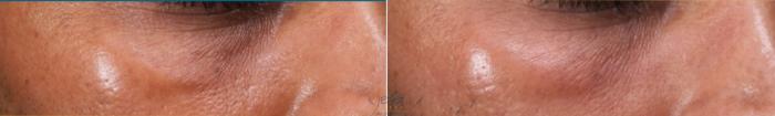 Before & After PRP Rejuventation Case 438 Right Oblique View in Vancouver, BC