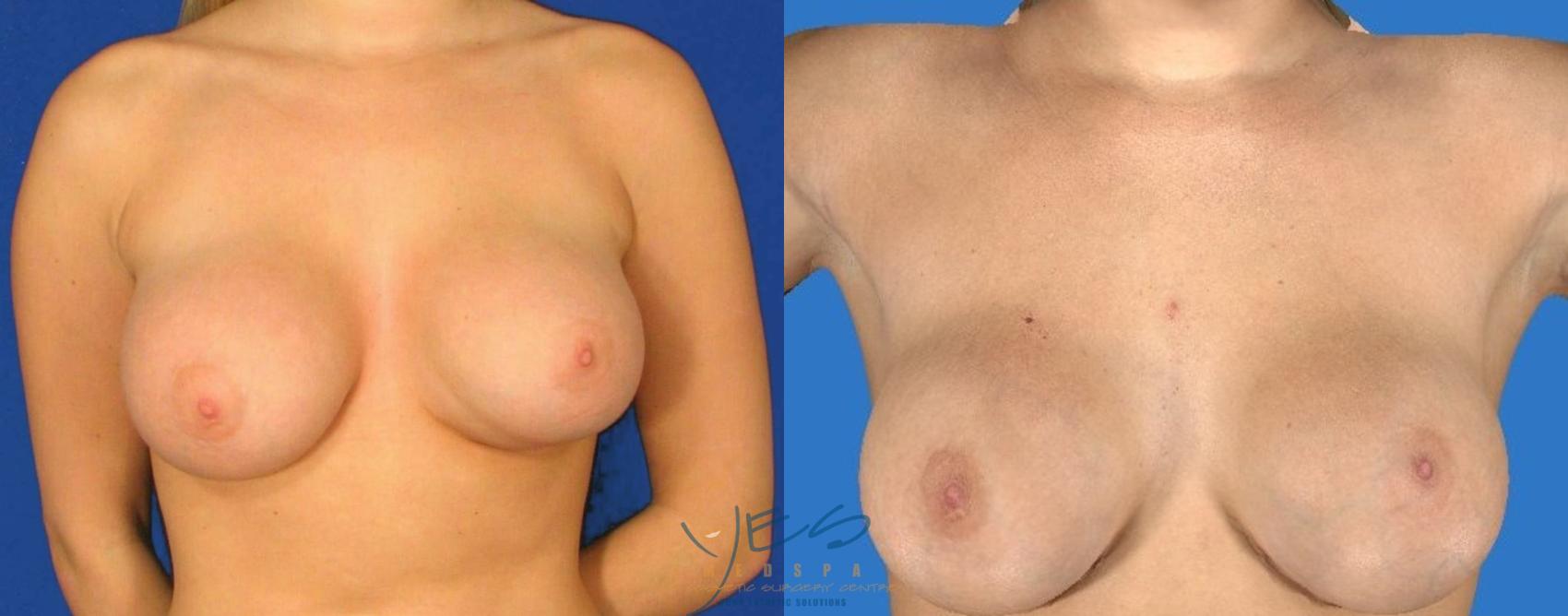 Before & After Revision Breast Surgery Case 105 Front View in Vancouver, BC