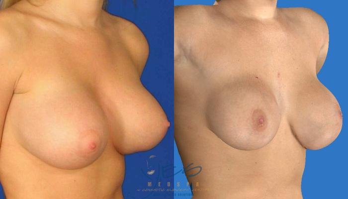 Before & After Revision Breast Surgery Case 105 View #2 View in Vancouver, BC