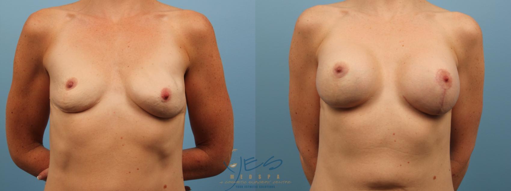 Before & After Revision Breast Surgery Case 137 Front View in Vancouver, BC
