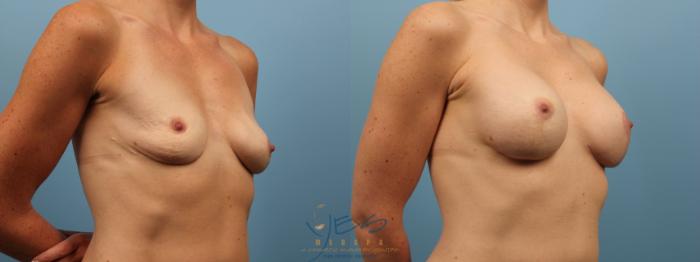 Before & After Revision Breast Surgery Case 137 Right Oblique View in Vancouver, BC