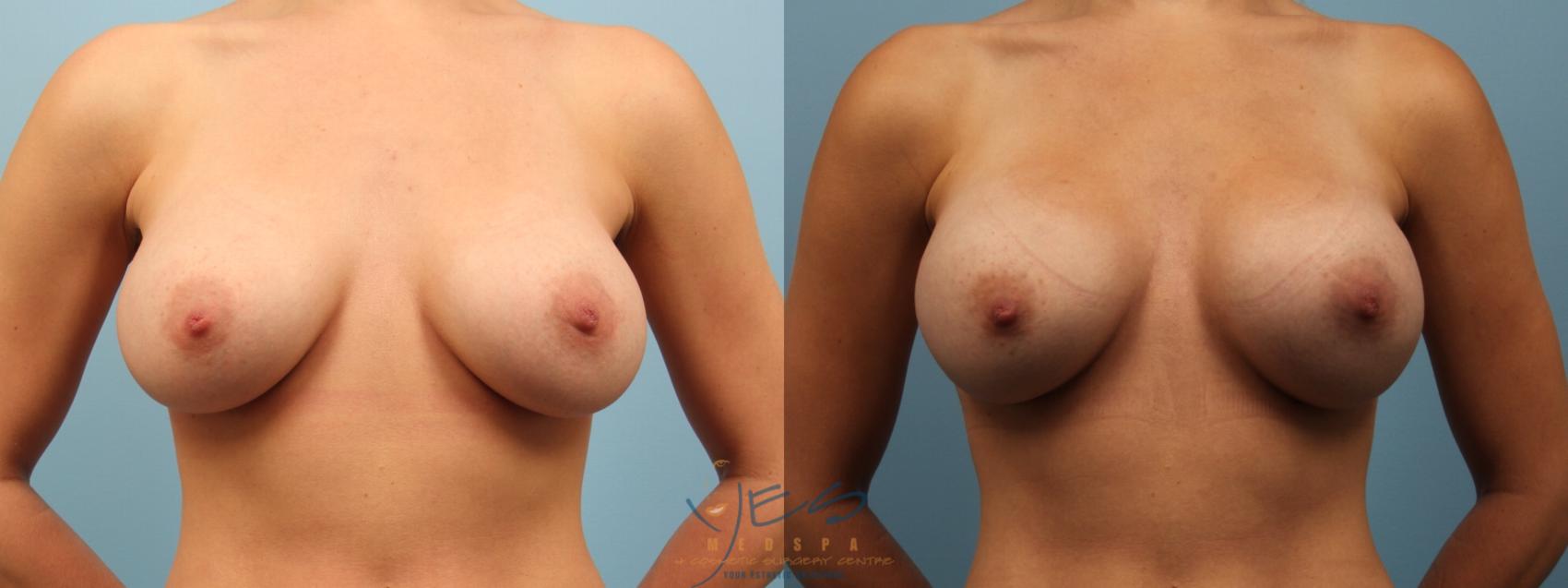 Before & After Revision Breast Surgery Case 161 View #1 View in Vancouver, BC