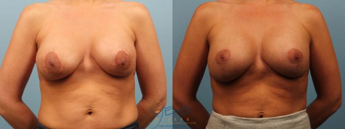 Before & After Breast Augmentation Case 272 Front View in Vancouver, BC