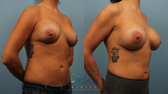 Before & After Revision Breast Surgery Case 279 Right Oblique View in Vancouver, BC
