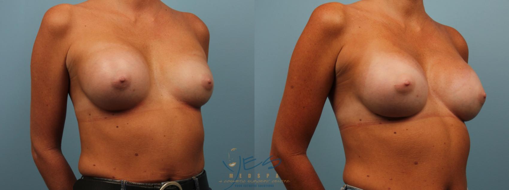 Before & After Revision Breast Surgery Case 286 Right Oblique View in Vancouver, BC