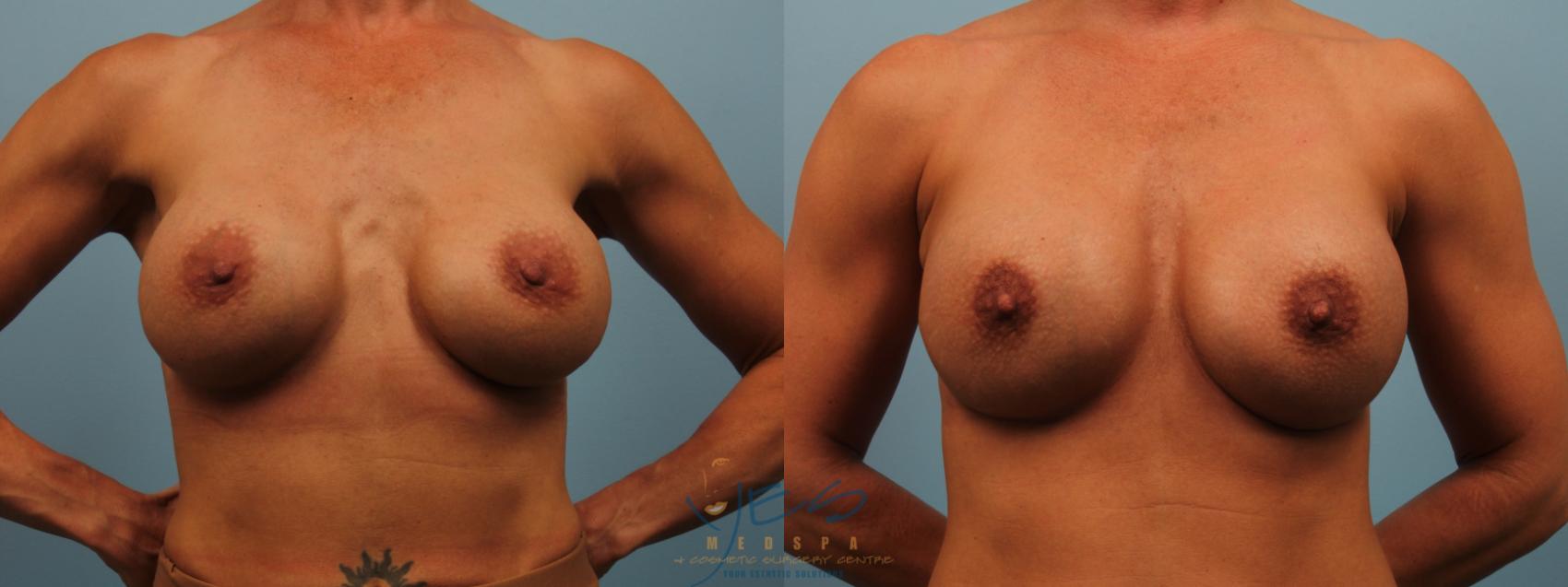 Before & After Revision Breast Surgery Case 290 Front View in Vancouver, BC