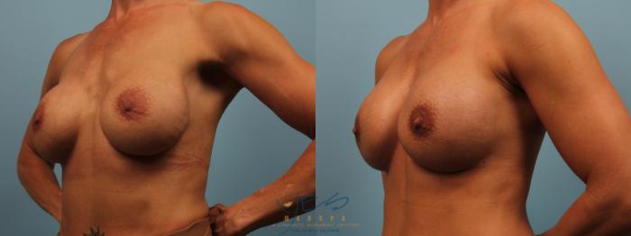Before & After Revision Breast Surgery Case 290 Left Oblique View in Vancouver, BC