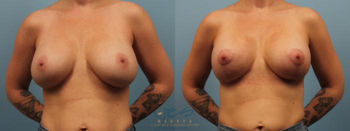 Before & After Breast Augmentation and Lift Case 301 Front View in Vancouver, BC