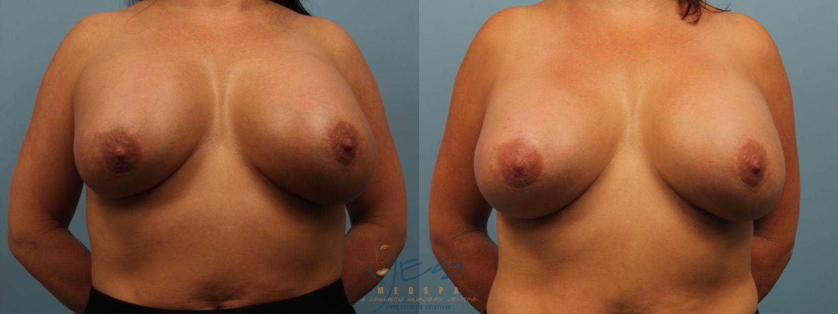 Before & After Revision Breast Surgery Case 302 Front View in Vancouver, BC