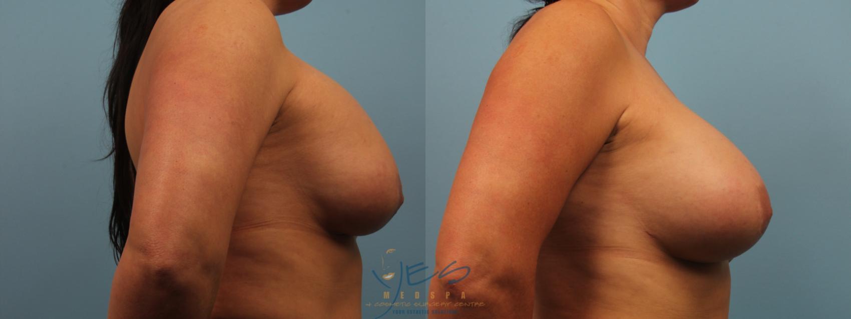 Before & After Revision Breast Surgery Case 302 Right Side View in Vancouver, BC