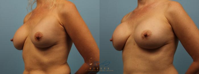 Before & After Revision Breast Surgery Case 321 Left Oblique View in Vancouver, BC