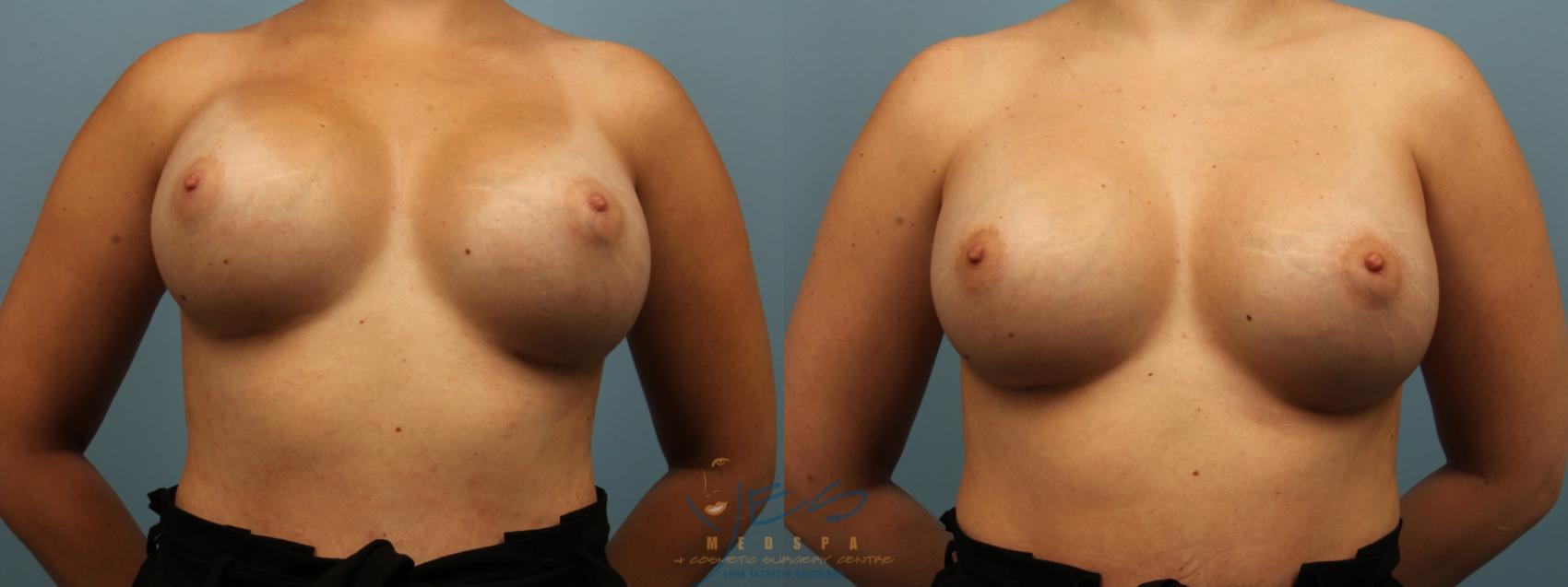 Before & After Revision Breast Surgery Case 325 Front View in Vancouver, BC