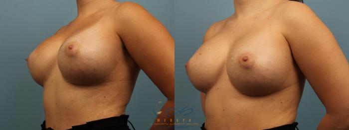 Before & After Revision Breast Surgery Case 325 Left Oblique View in Vancouver, BC