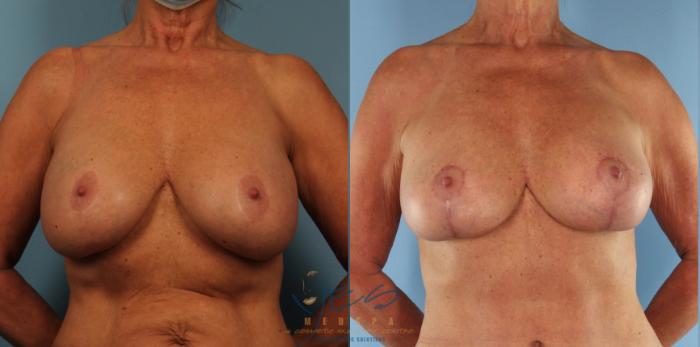 Before & After Revision Breast Surgery Case 430 Front View in Vancouver, BC