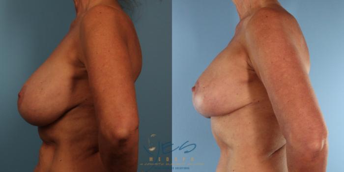 Before & After Breast Augmentation and Lift Case 430 Left Side View in Vancouver, BC