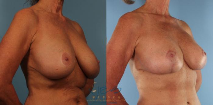 Before & After Revision Breast Surgery Case 430 Right Oblique View in Vancouver, BC
