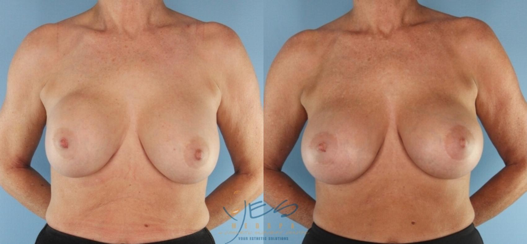 Before & After Revision Breast Surgery Case 437 Front View in Vancouver, BC