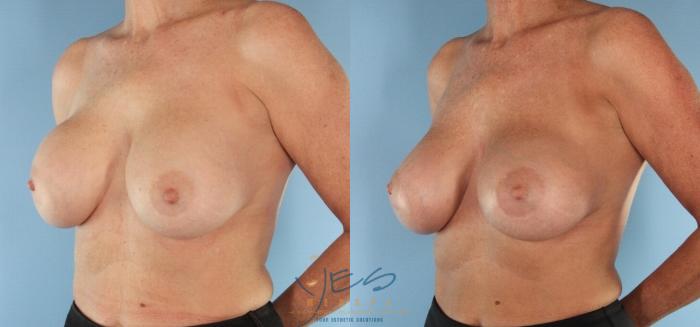 Before & After Revision Breast Surgery Case 437 Left Side View in Vancouver, BC