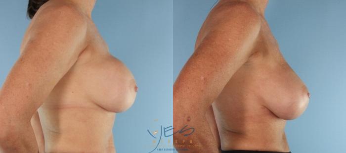 Before & After Revision Breast Surgery Case 437 Right Side View in Vancouver, BC