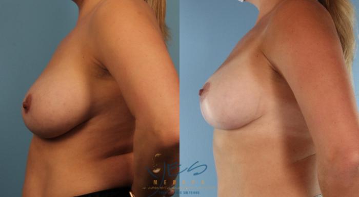 Before & After Revision Breast Surgery Case 439 Left Side View in Vancouver, BC